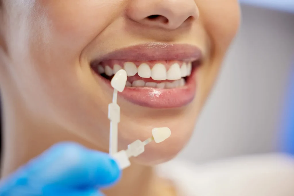 preparing to get veneers athens ga