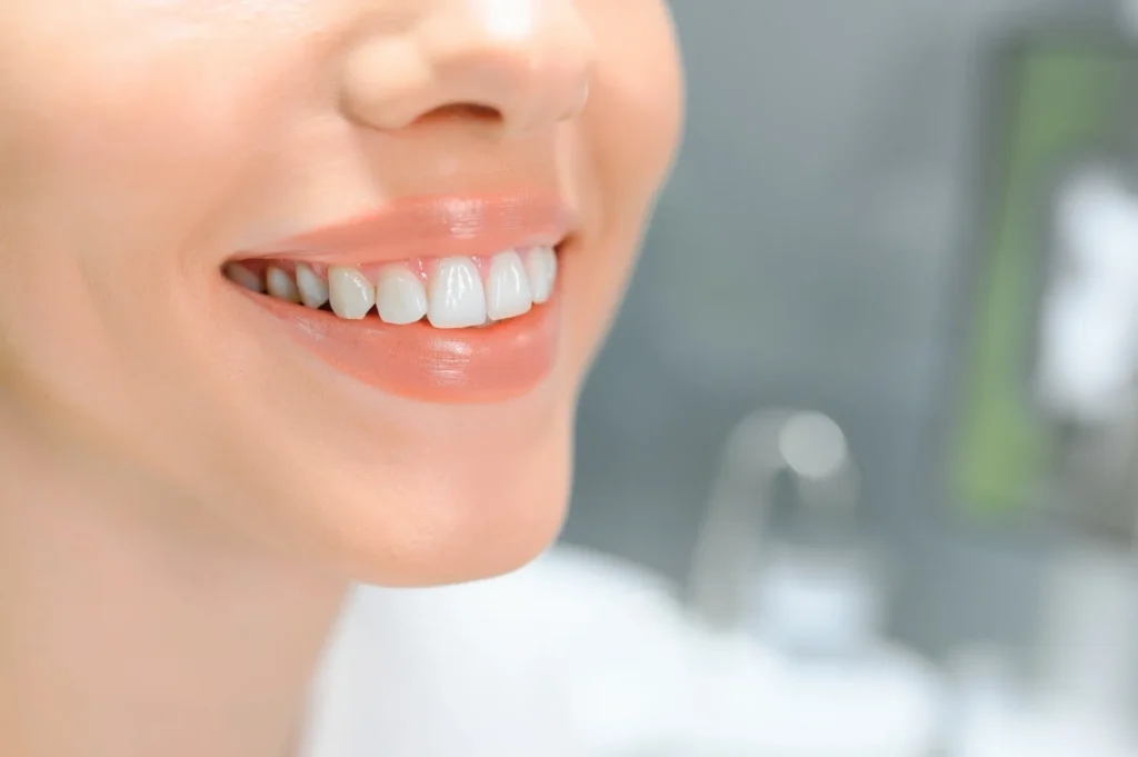 after teeth whitening athens ga