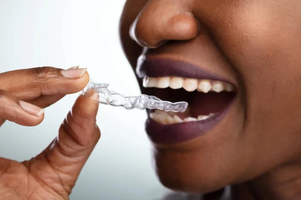patient putting on clear aligners athens ga